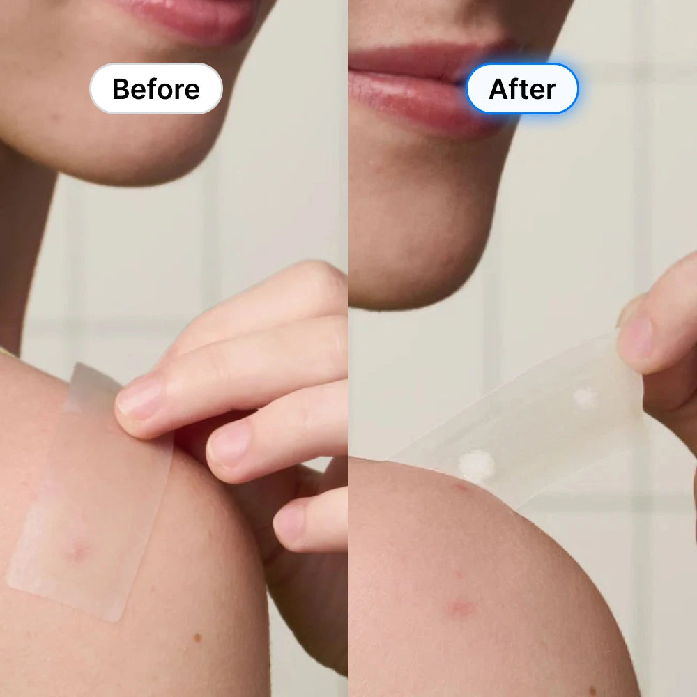 Rosemore Clear Skin Hydrocolloid Roll