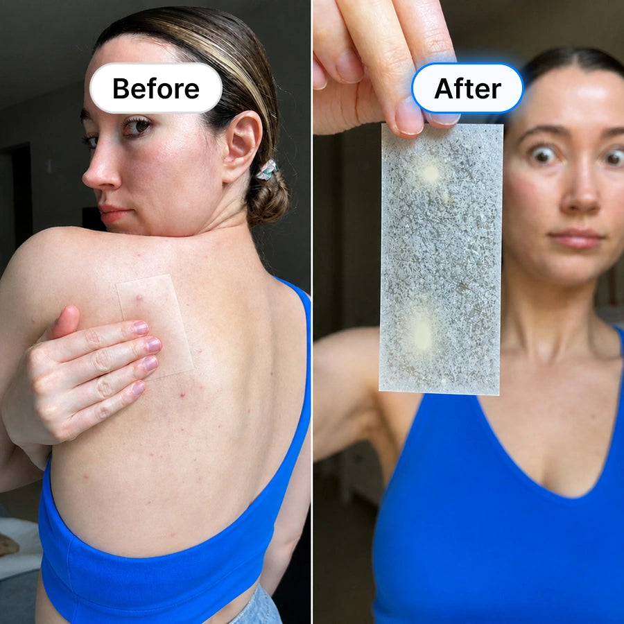 Rosemore Clear Skin Hydrocolloid Roll