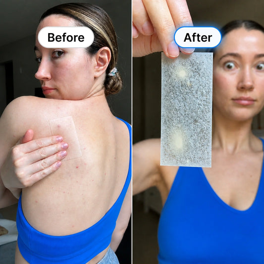 Rosemore Clear Skin Hydrocolloid Roll